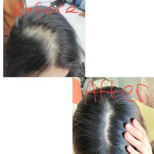 Customer before-and-after scalp photo shared in an Etsy review for House of Herbs Hair Growth Oil.